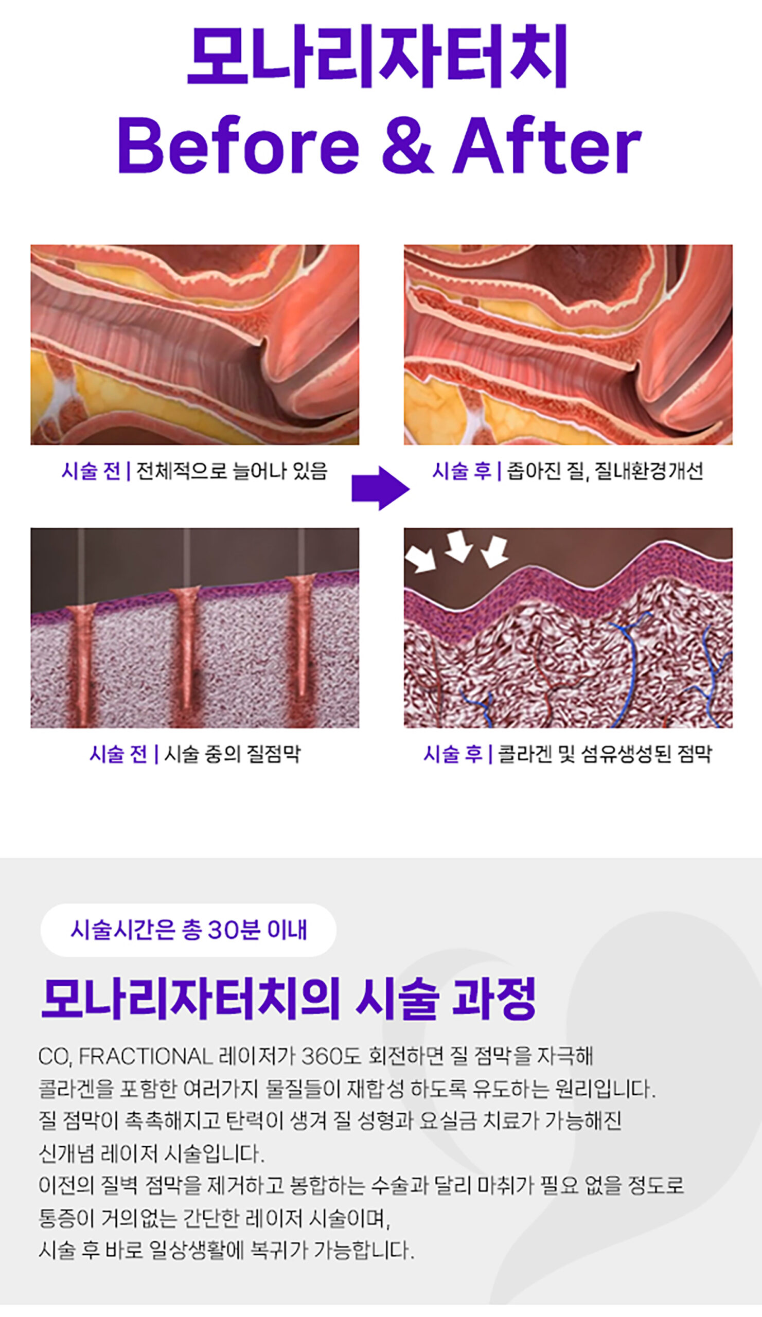 청담산부인과-랜딩페이지_모나리자&소음순_03